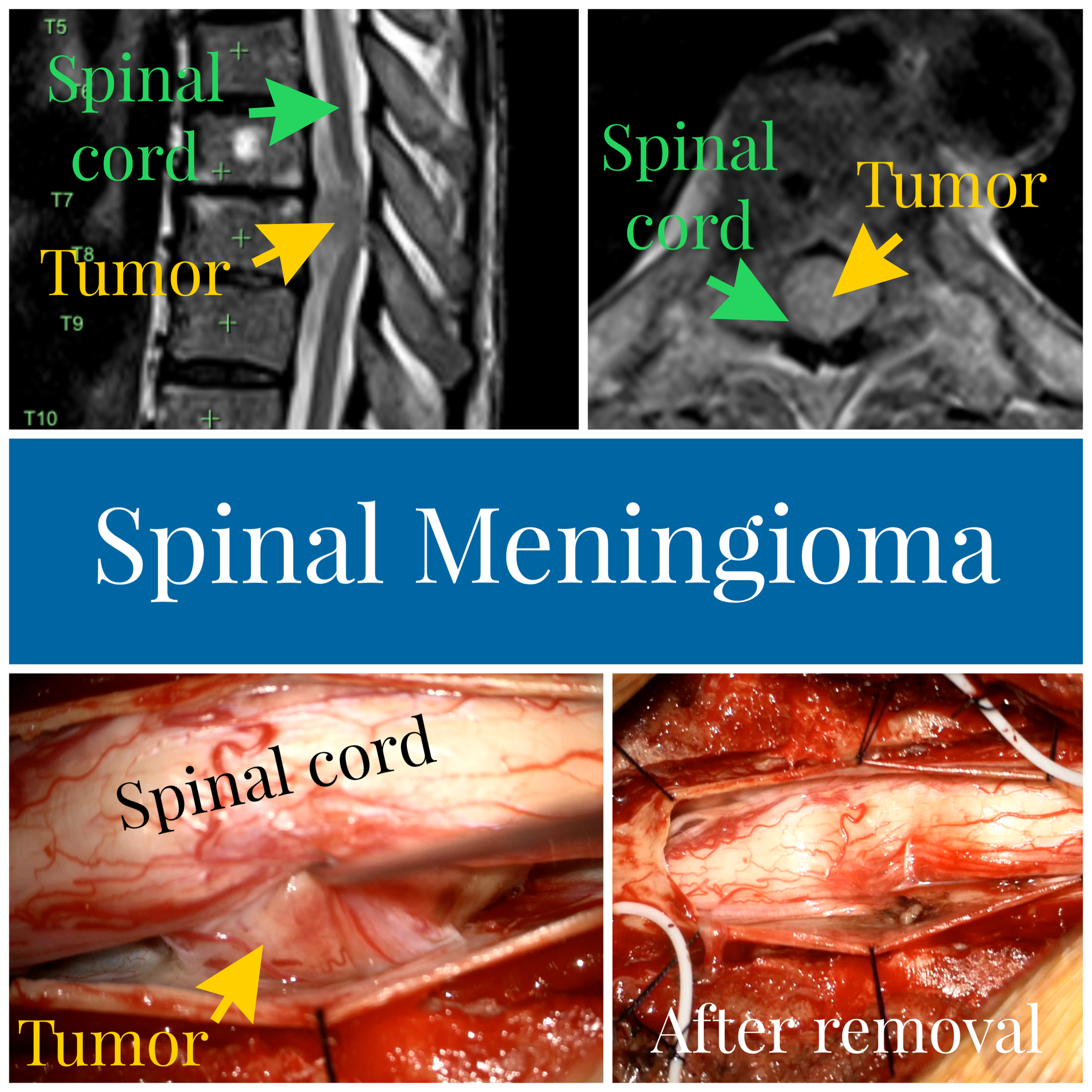 Meningioma — Matthew Mian, MD